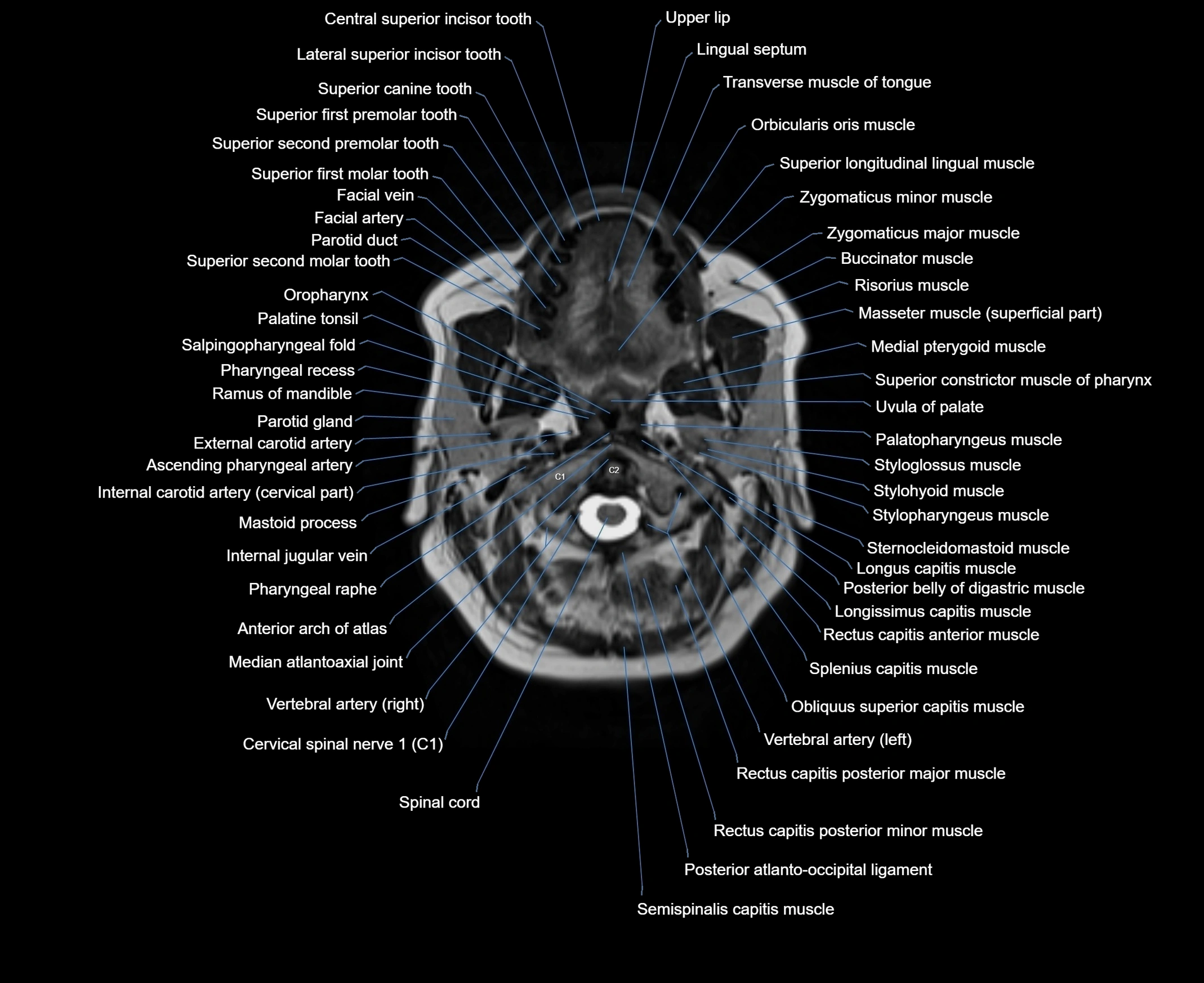 MRI Neck 3D labelled cross section anatomy axial 3t image-00001-00025.webp